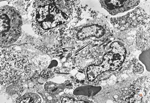 bone marrow - crystalloid inclusions Charcot-Leyden crystals formation